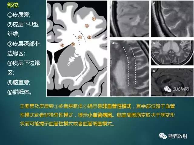 脑白质疏松(la):小动脉病变导致的白质纤维脱髓鞘;t2-flair呈较
