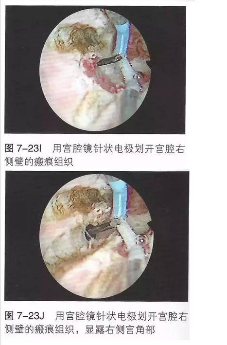 【病例分享一】宫腔镜宫腔粘连电切术