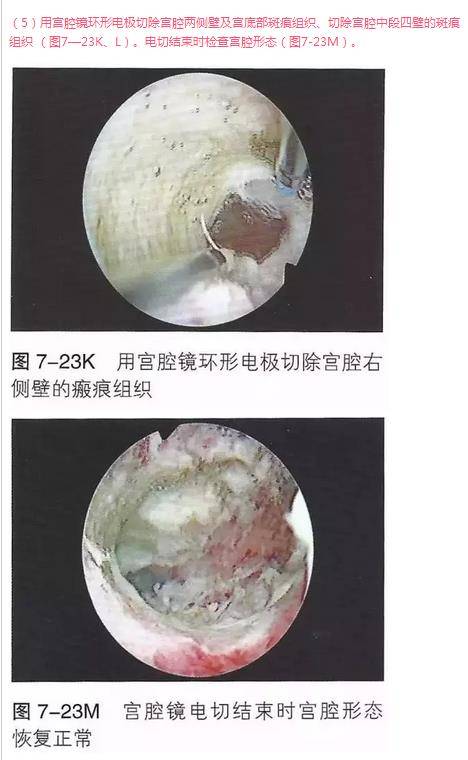 【病例分享一】宫腔镜宫腔粘连电切术