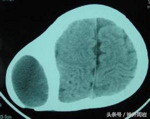 医学新闻 正文  第二种叫"帽状腱膜下血肿",常发生于帽状腱膜层和骨膜