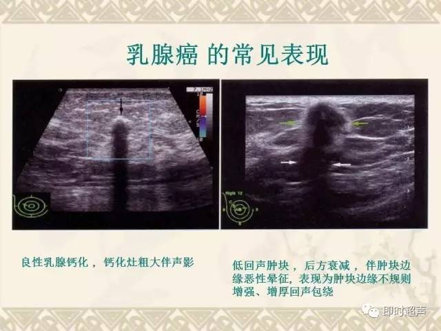 彩色多谱勒超声在乳腺良恶性肿瘤鉴别诊断中的应用价值