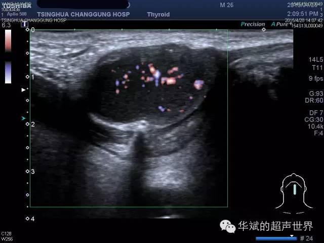 颈部正中的甲状舌管囊肿,内部回声呈致密的细点状,酷似实性病变.