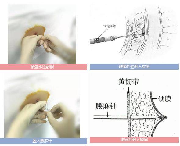 与患者皮肤垂直,缓慢刺入;穿刺针依次穿刺经过皮肤,皮下脂肪,棘上韧带