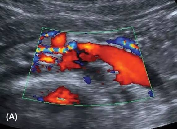胡桃夹综合征:超声新技术诊断