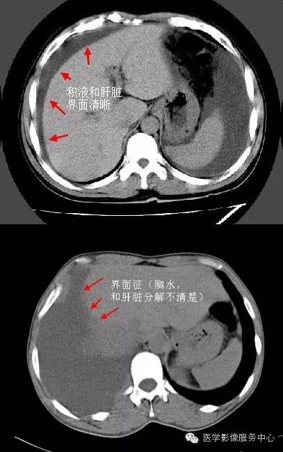 鉴别胸腹水,需牢记这四个征象