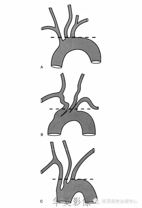 解剖基础:主动脉弓的3种分支分型和9种变异