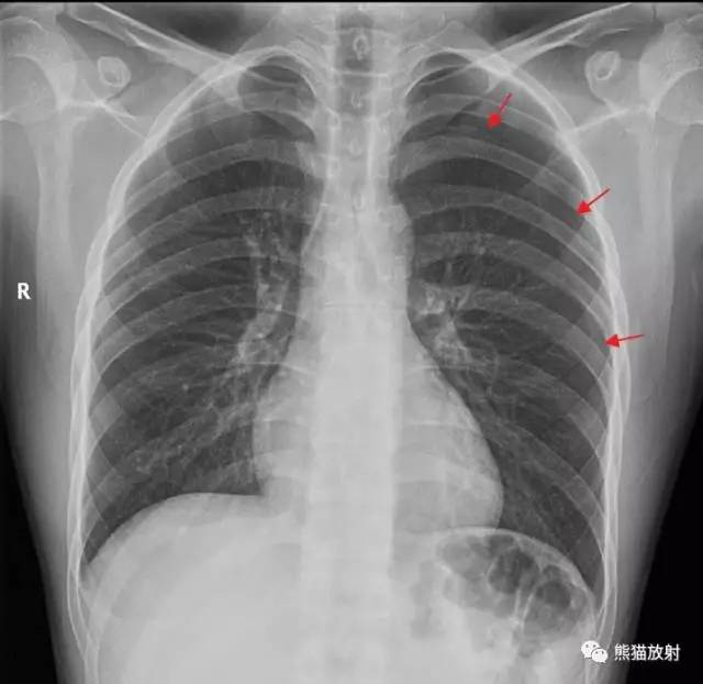 影像学上如何判断气胸时肺被压缩了多少?