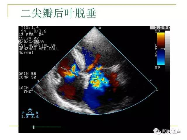 二尖瓣关闭不全的超声表现