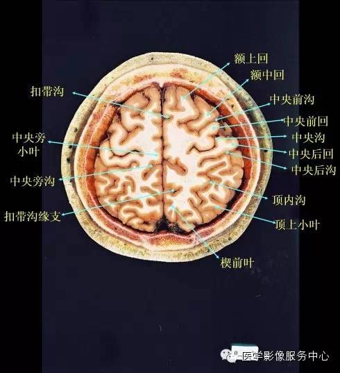 影像学基础:神经系统---大脑的断层解剖