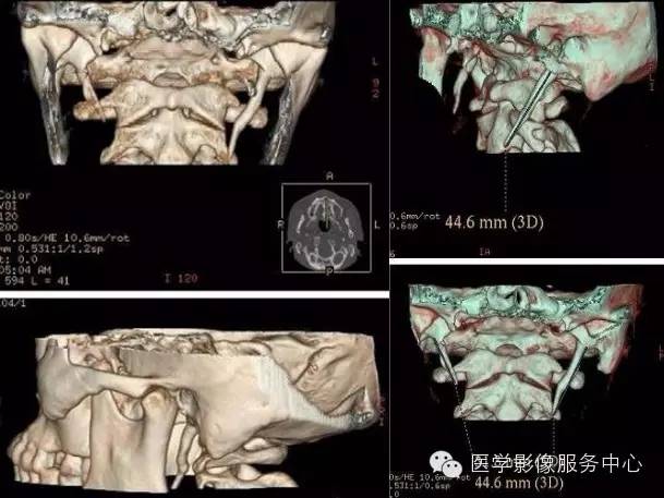 【图文详解】茎突过长的影像诊断及注意事项