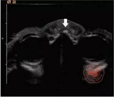 胎儿鼻骨超声检查