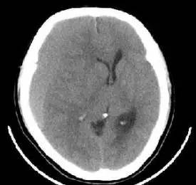 慢性硬膜下血肿ct图片