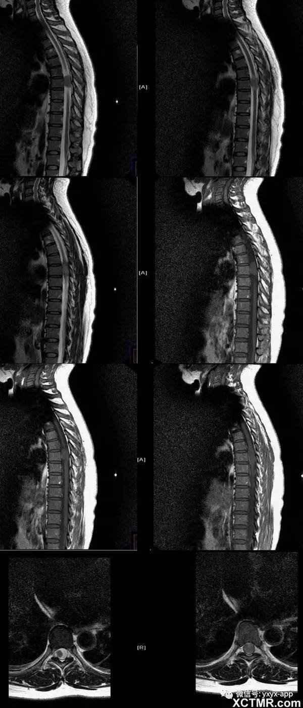脊膜瘤mri病例