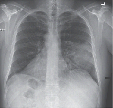 患者 岁时因咳嗽而拍胸片发现为内脏逆位(situs inversus.