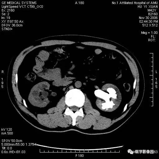 泌尿系结石的ct诊断