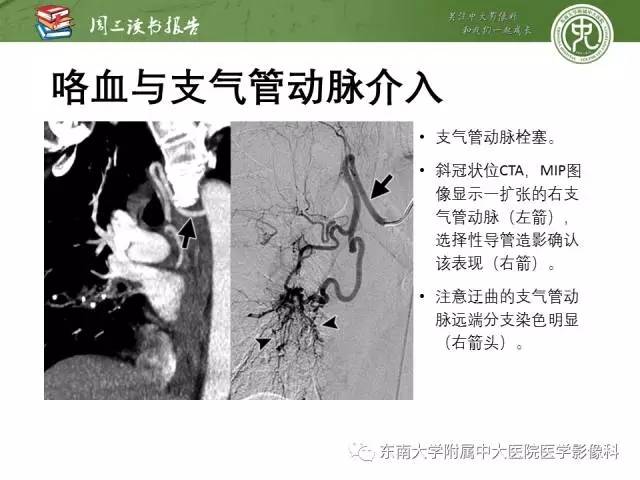 支气管动脉:解剖,功能及增粗和异常改变影像表现