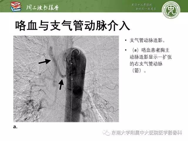 支气管动脉:解剖,功能及增粗和异常改变影像表现
