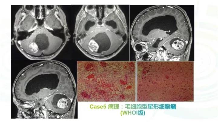 毛细胞型星形细胞瘤的影像诊断全攻略