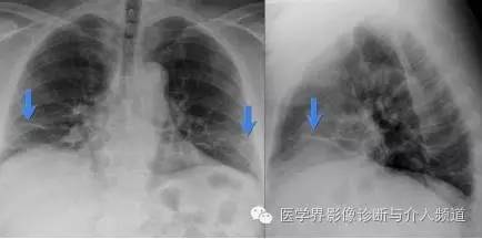 "盘状肺不张"的影像学诊断