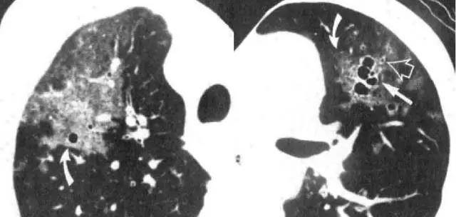 卡氏肺囊虫肺炎:免疫力低 磨玻璃影 实变 间质增生 上肺囊状改变