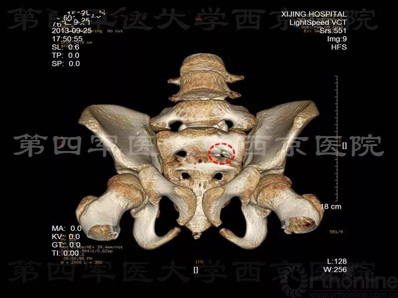 病例探秘|10岁女童左骶尾部进行性疼痛4月是为何?