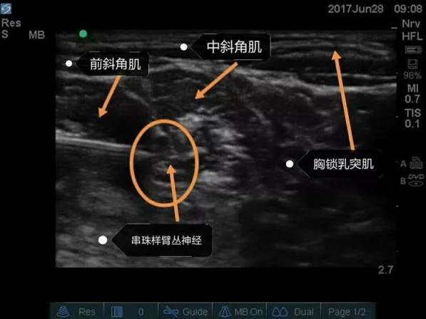 如何从零开始学习超声引导下神经阻滞?这篇文章你不可