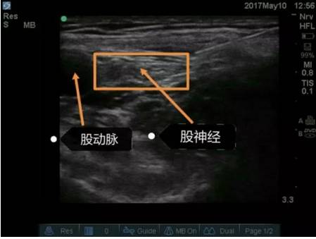 医学新闻 正文  超声引导下股神经阻滞技术可以为髋关节及膝关节置换