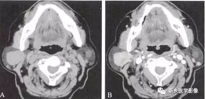 【读书笔记】腮腺5种肿瘤的ct表现