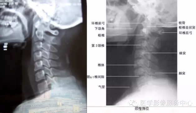 图文详解项韧带钙化