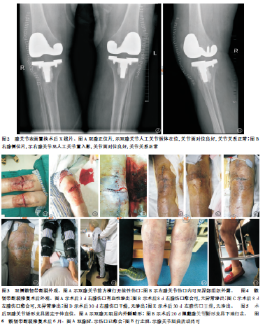 膝关节表面置换术后髌韧带断裂1例