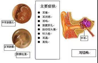 中耳炎需要手术,但不愿手术或不能手术该注意哪些?