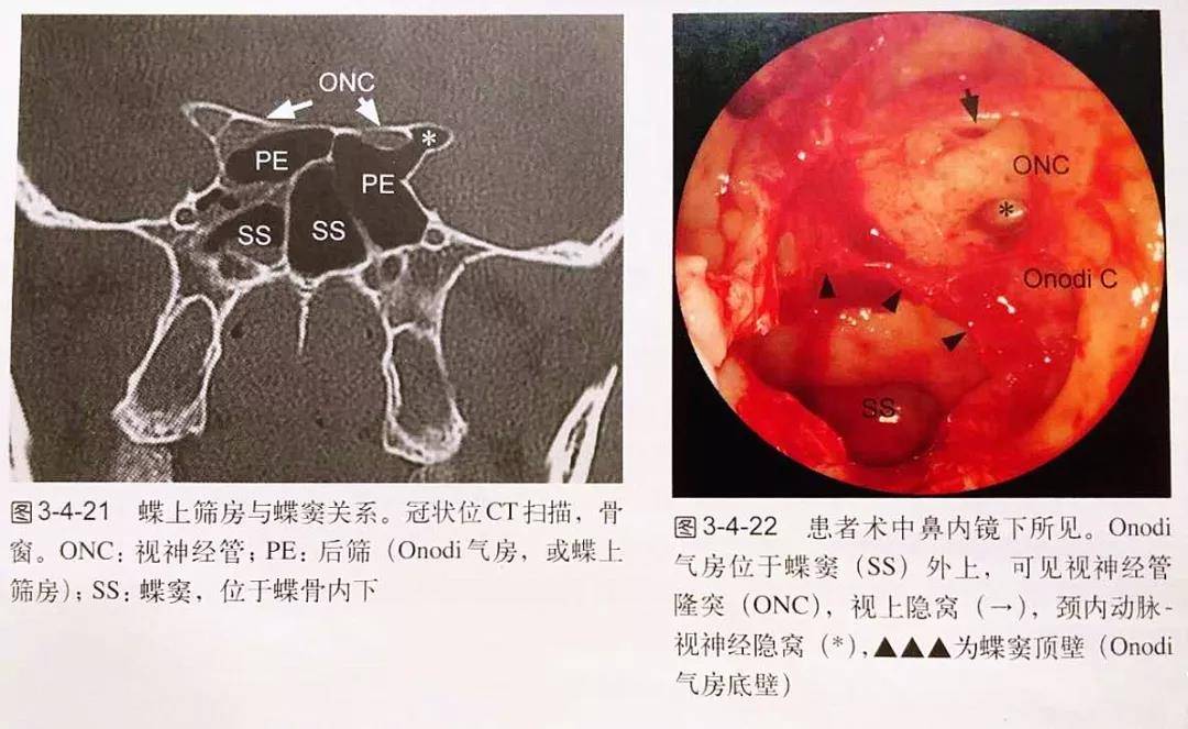 图文详解:手把手教您蝶窦开放手术