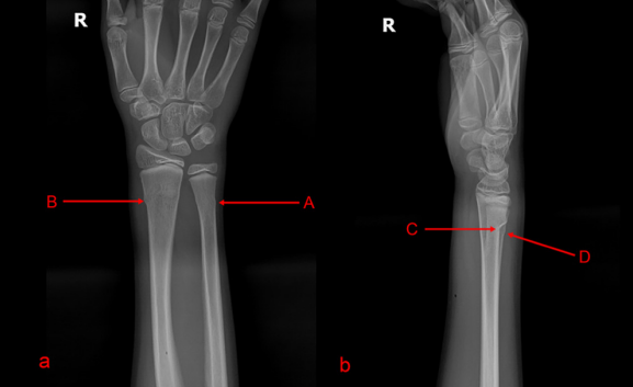 讨论     x线片示右侧尺骨和桡骨的典型环状骨折改变.