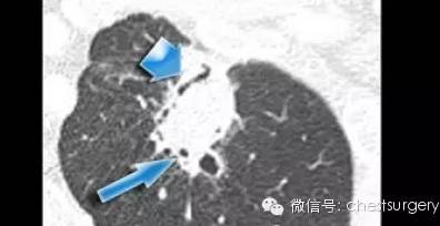 含气支气管征
