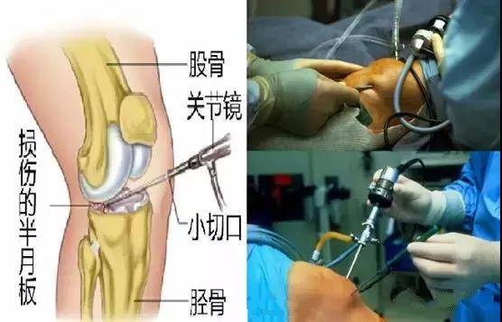 善待你的"半月板"