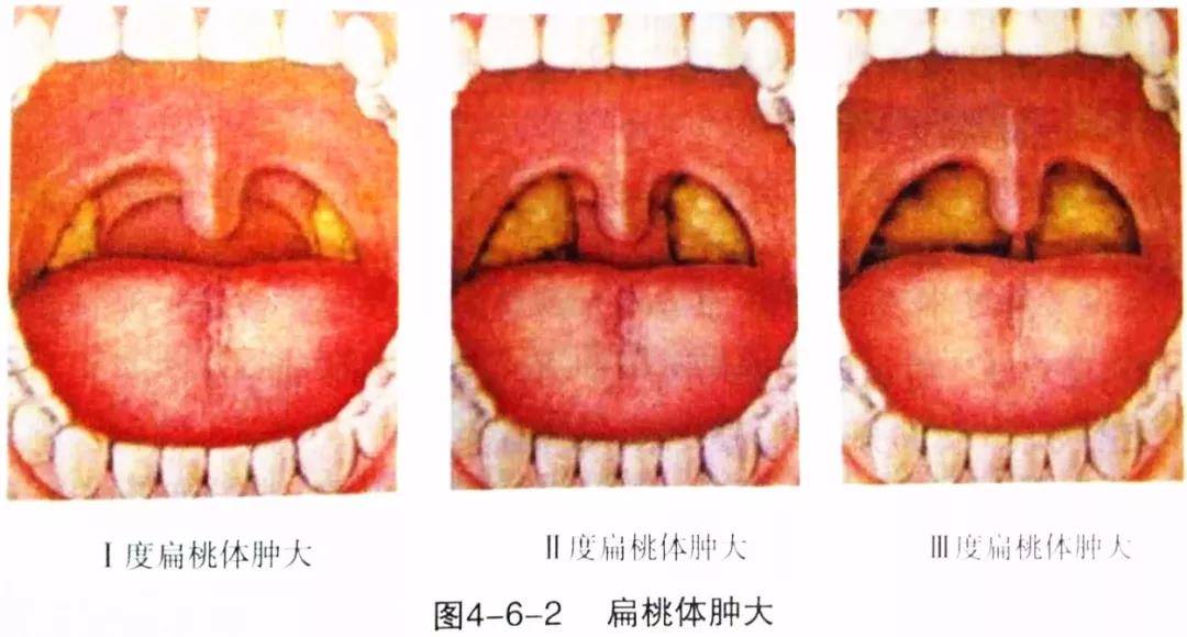 舌腭弓与咽腭弓变化:呈带状充血,边缘水脚,肥厚,粘连等.