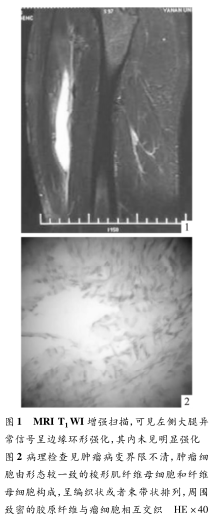左股直肌韧带样型纤维瘤病1例