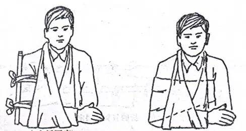 无夹板时,可用宽布带或三角巾将患肢固定于自身躯干上.