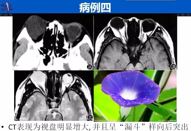 牵牛花综合征的ct和mri诊断