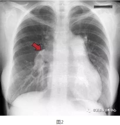 胸片容易忽略的15个异常征象