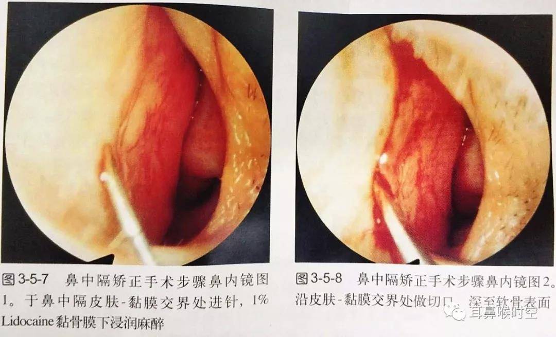 鼻中隔偏曲的矫正的手术方法