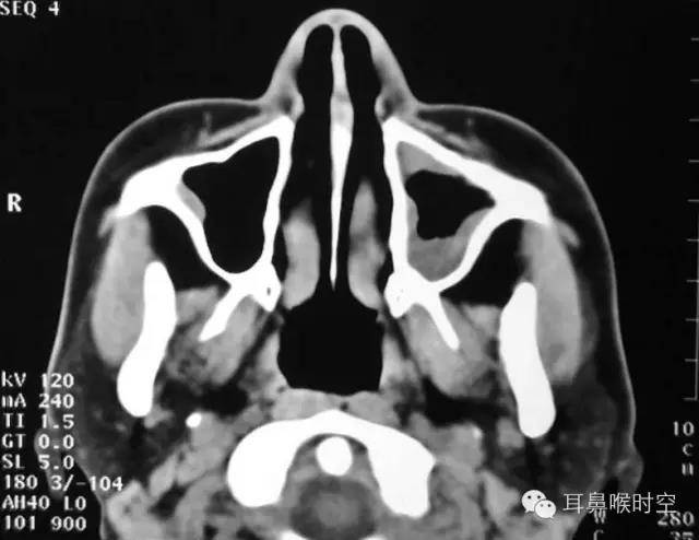 急性左上颌窦炎  粘液囊肿 ct表现 受累窦腔扩大,其内为均匀一致的