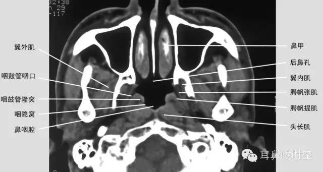 从ct片看鼻和鼻窦病变你诊断到位了吗