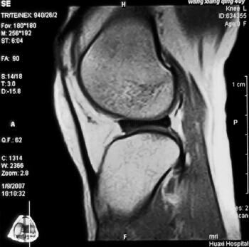 年轻人运动不当致半月板损伤 首选治疗是什么?