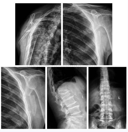 就诊于北京大学人民医院急诊,行x 线检查提示为"左肩胛骨骨折,左肋骨