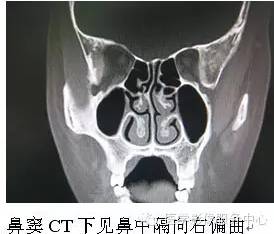 鼻中隔偏曲的影像学表现