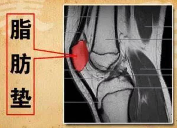 膝关节太"胖"?有可能是髌下脂肪垫损伤惹的祸