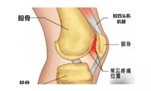 膝关节太胖有可能是髌下脂肪垫损伤惹的祸