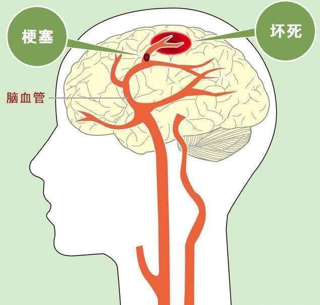 脑梗塞知识知多少？