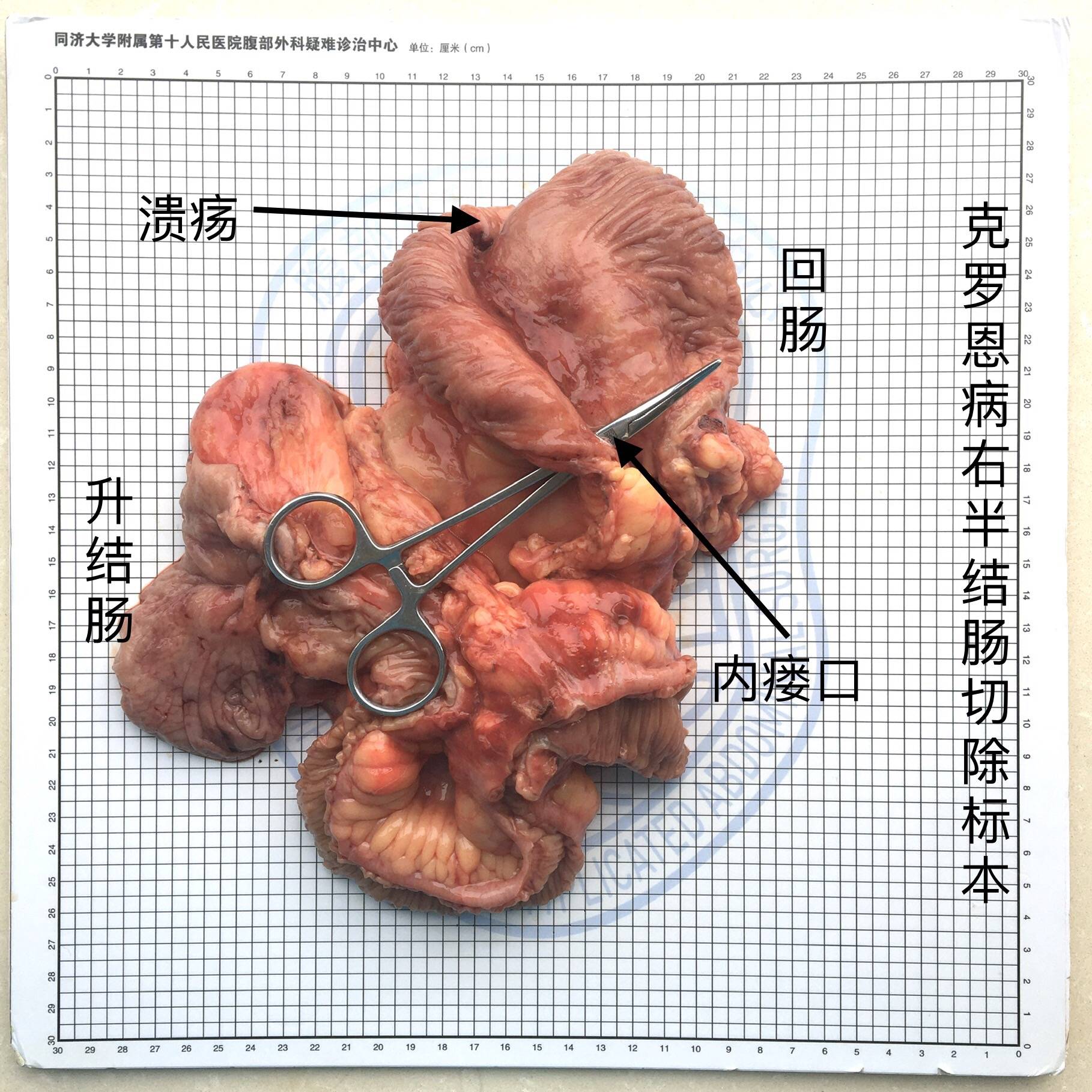 【6.16】尹路教授:腹腔镜下右半结肠切除术(回肠造口术?